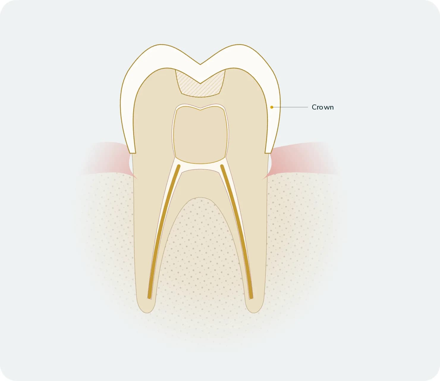 Illustration: Zirconium Crowns, after treatment