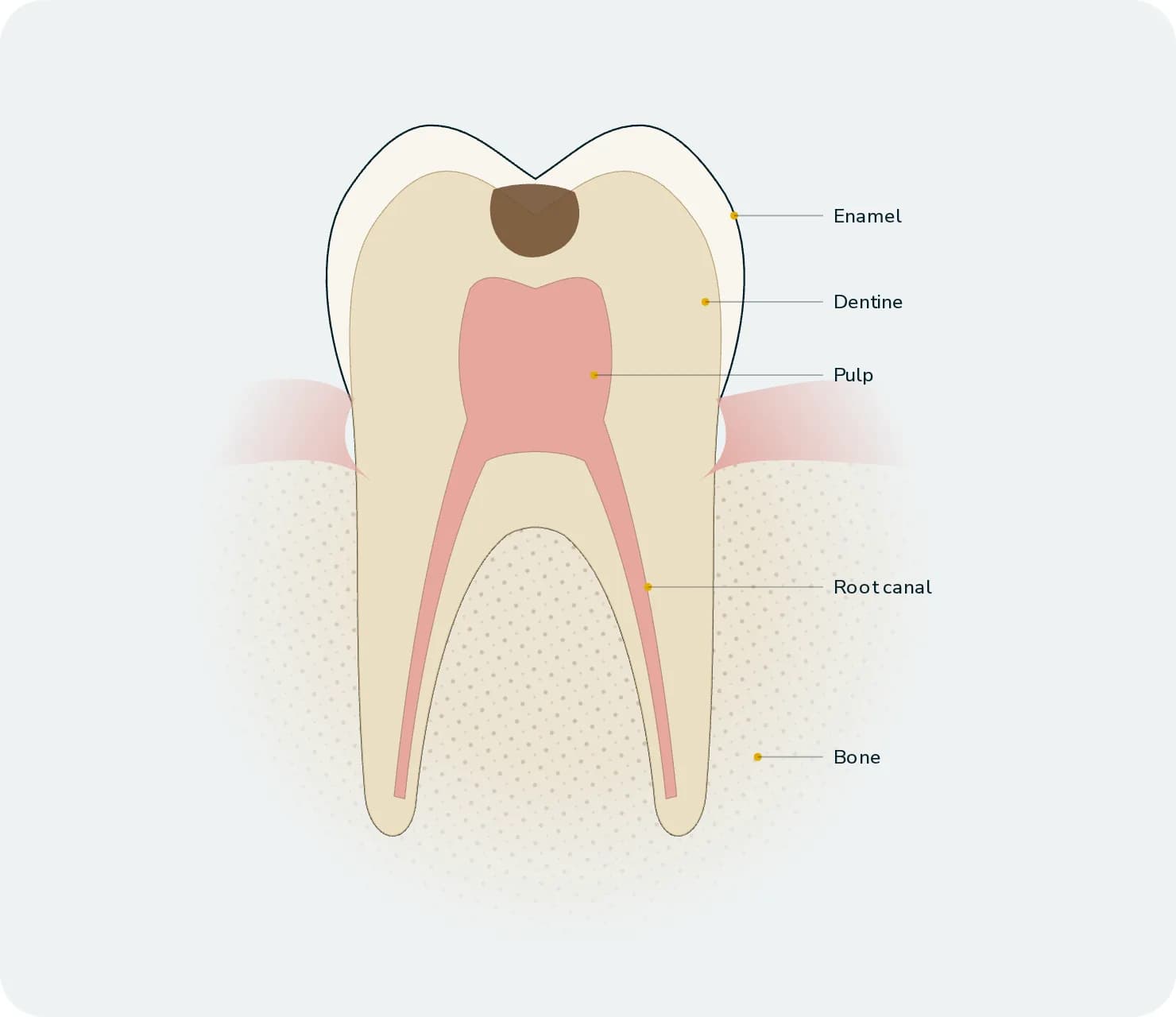 Illustration: Zirconium Crowns, before treatment