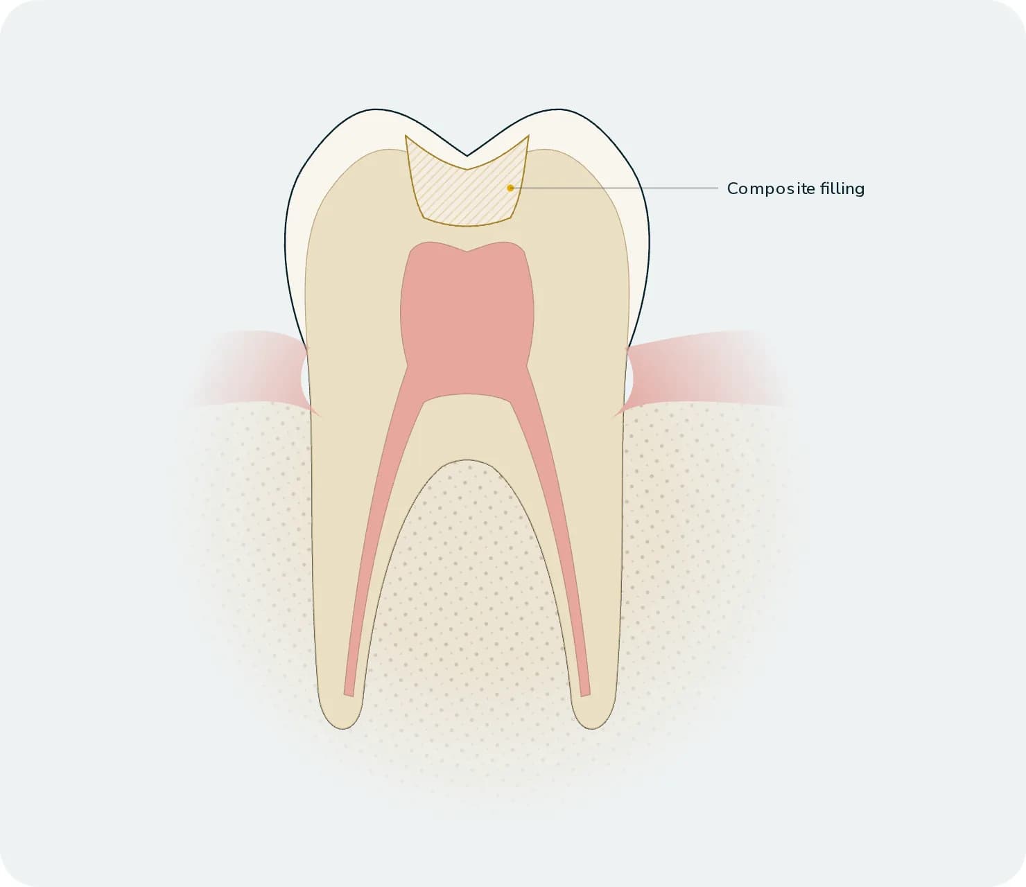 Illustration: Dental Fillings, after treatment