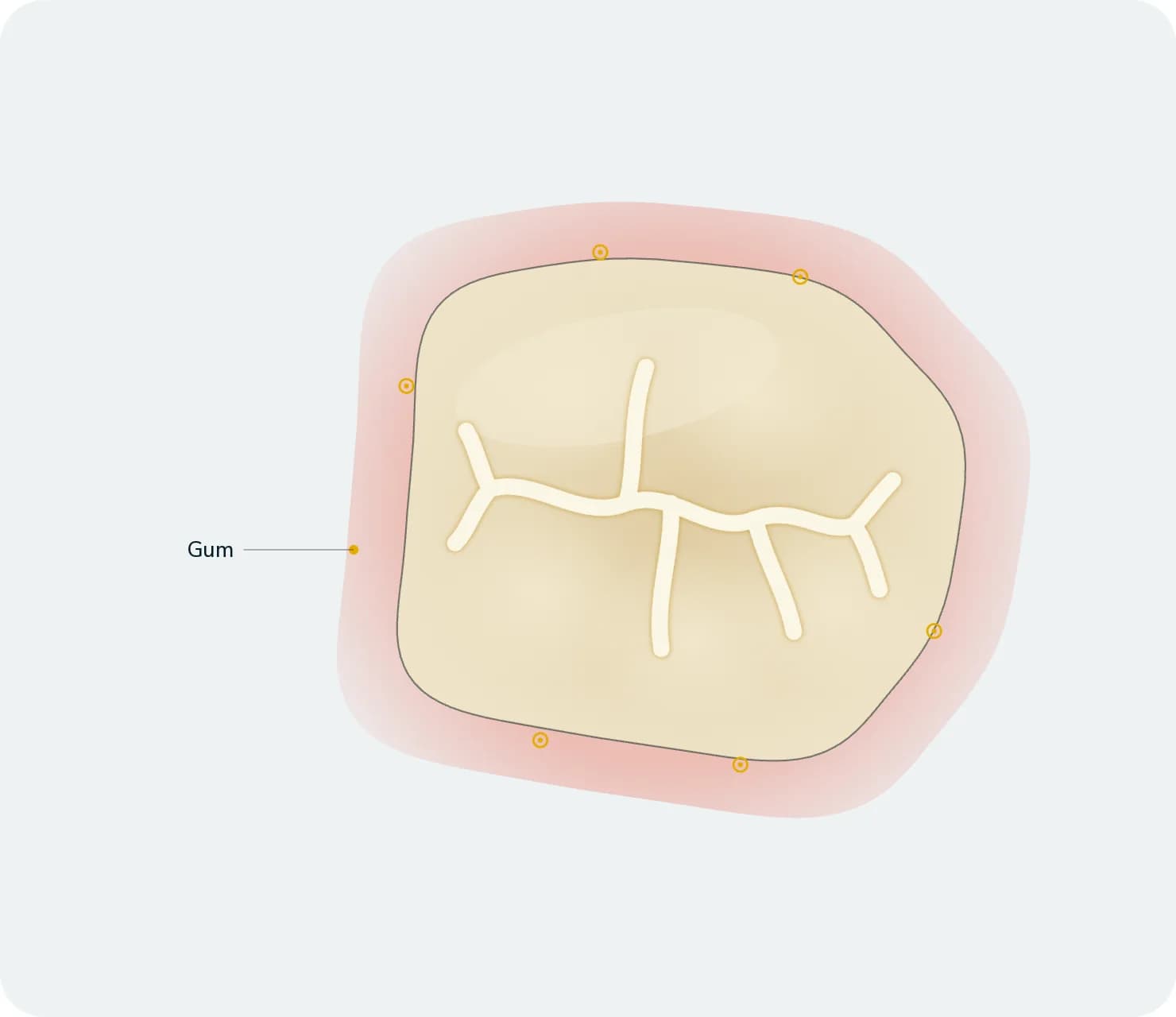 Illustration: Gum Treatment, after treatment