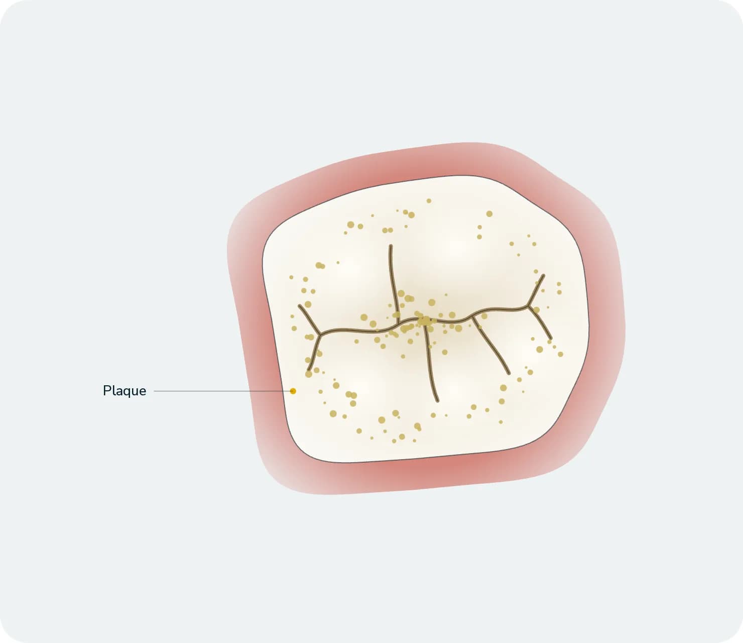 Illustration: Gum Treatment, before treatment