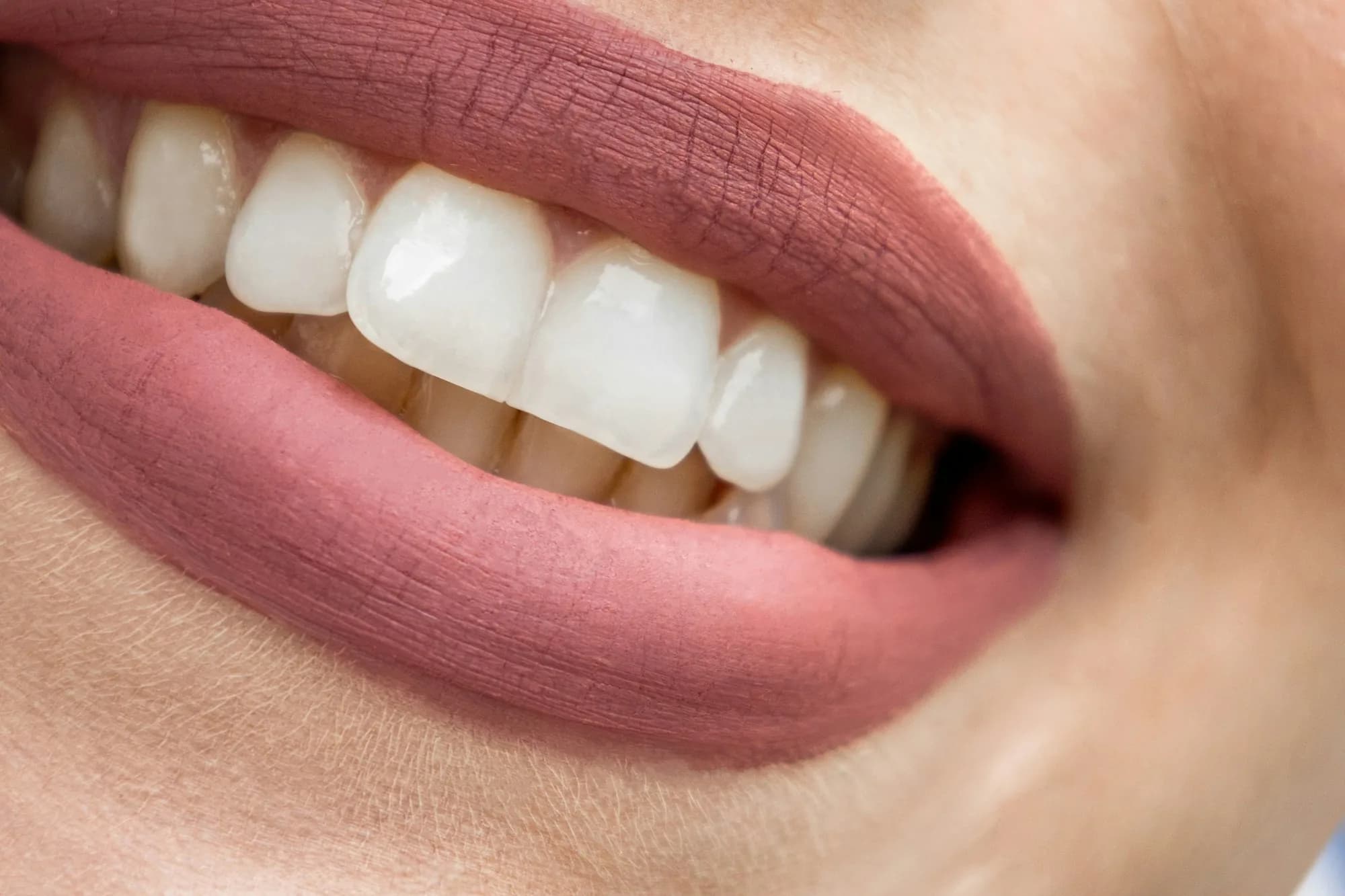 Close-up of a smile with bright white teeth