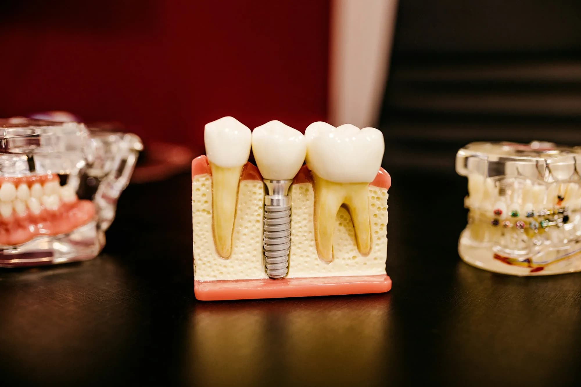 Dental implant model showing crown, screw and jawbone in cross-section